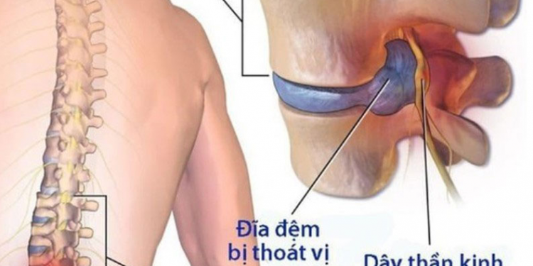 Bị Bệnh Thoát Vị Đĩa Đệm Kiêng Ăn Gì Và Biến Chứng Của Nó