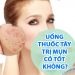 【HOT】Thật Hư: Uống Thuốc Tây Trị Mụn Có Tốt Không?