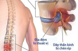 Bị Bệnh Thoát Vị Đĩa Đệm Kiêng Ăn Gì Và Biến Chứng Của Nó