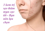 Review kem trị sẹo thâm mụn hiệu quả, giá cả phải chăng