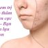 Bị Mụn Có Nên Dùng Kem Che Khuyết Điểm Không? Xem Ngay