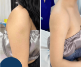 Tiêm tan mỡ nách có hiệu quả không? Địa chỉ tiêm tan mỡ uy tín